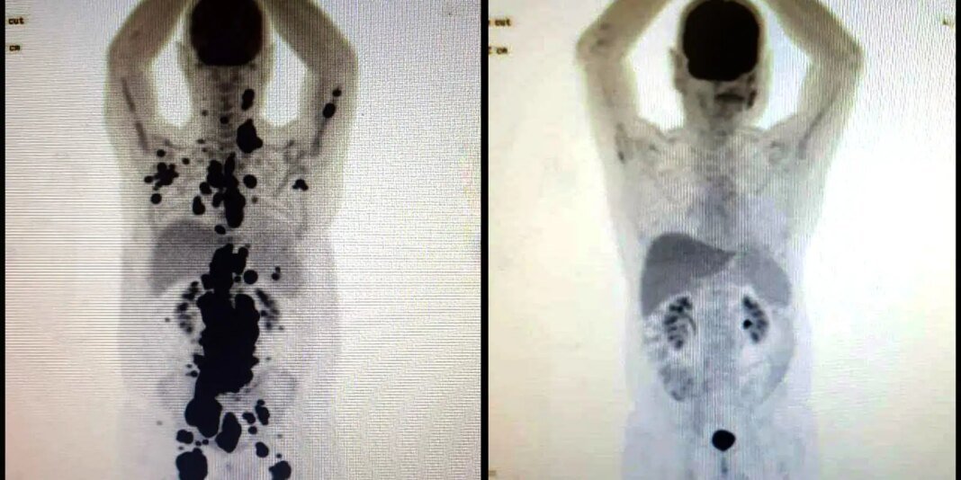 cancer-antes_depois.jpg